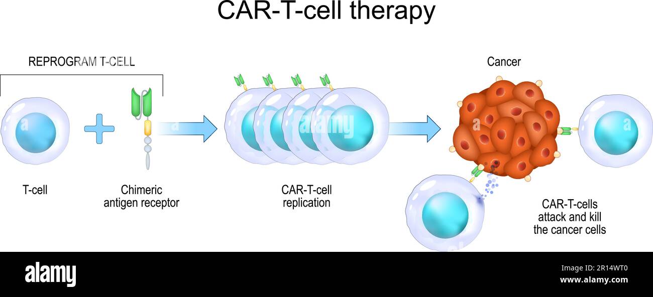CAR-T-Zell-Therapie. Krebsimmuntherapie. Abtötung von Tumorzellen. Gentechnisch hergestellt. Personalisierte Medizin. Vektordarstellung Stock Vektor
