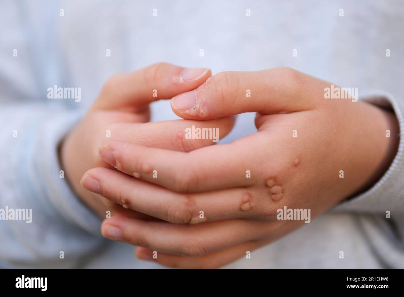 Hand mit Warze Mann Haut Nahaufnahme Hände von jungen Teenager Mädchen sind mit Warzen übersät eine Menge Papillome Virusinfektion auf Händen Berührung Kratzer betrachten nahe Nagel Virusinfektion Wucherungen an Fingern Stockfoto