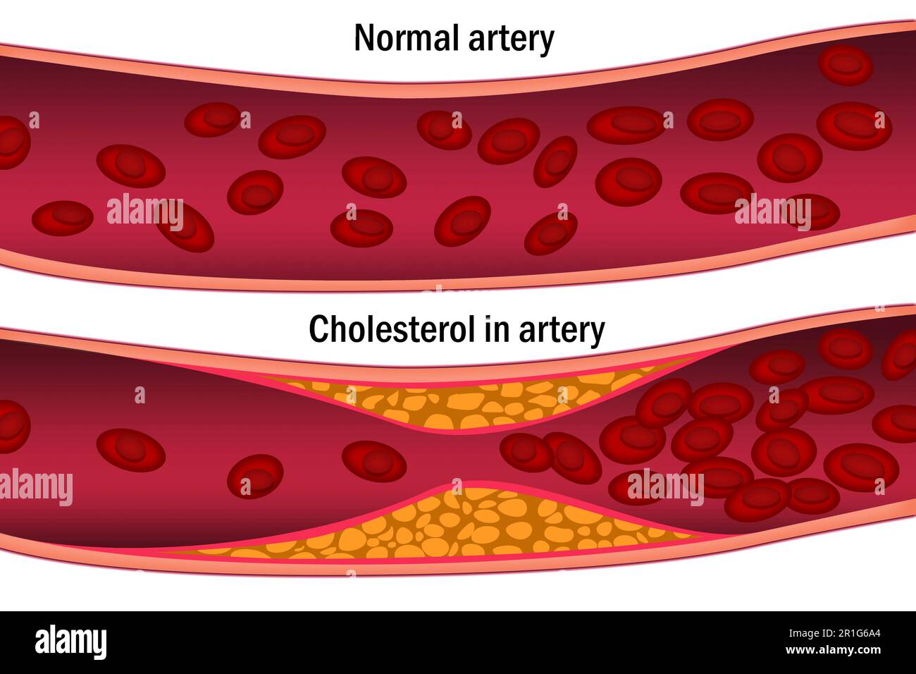 Cholesterin in der Arterie. Medizinisches Konzept, 3D-Rendering Stockfoto