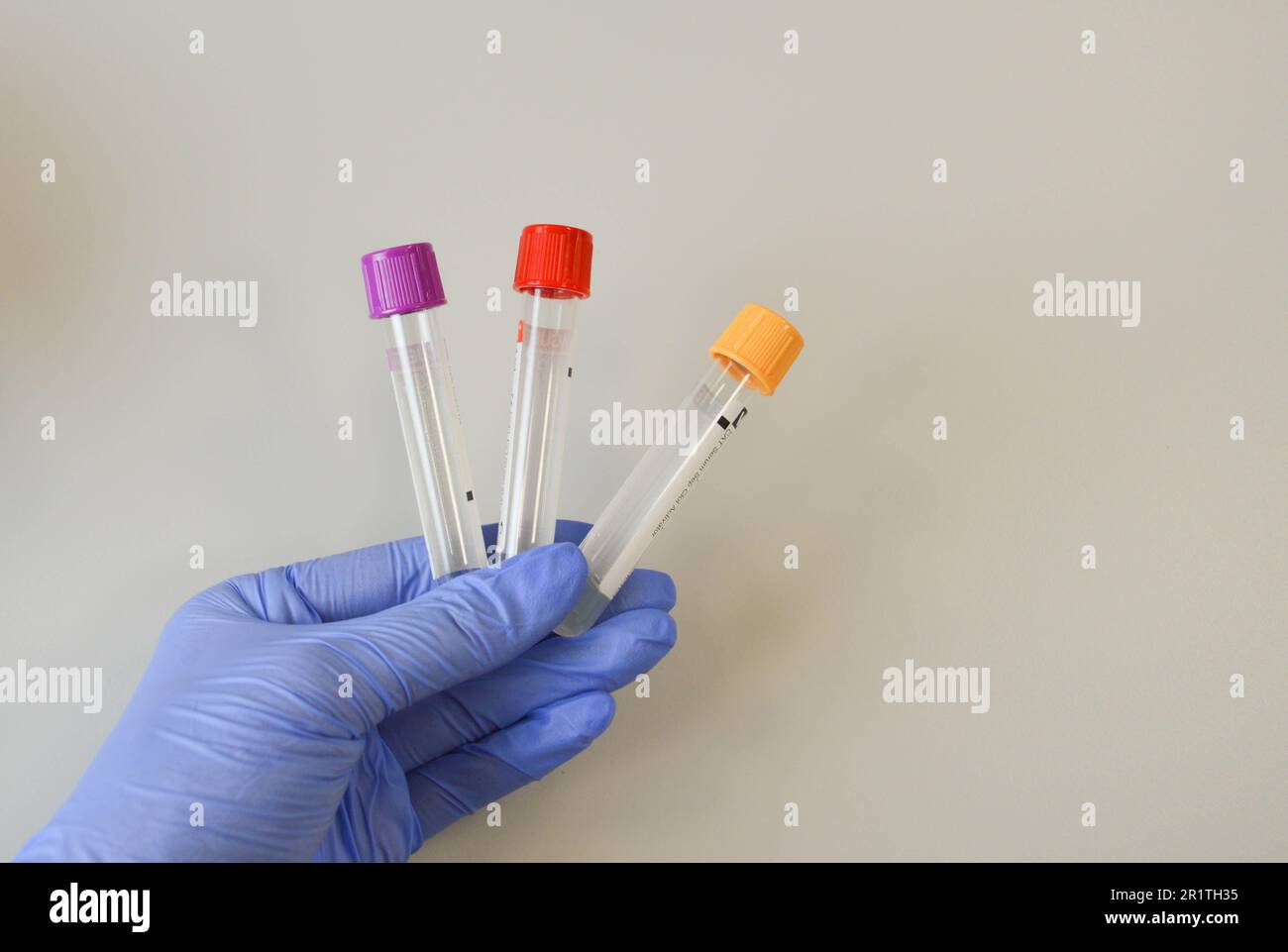 Krankenschwester, die das Blutprobenröhrchen mit Resultat Coronavirus Test hält. 2019-nCoV-Virus-Diagnoselabore. Stockfoto
