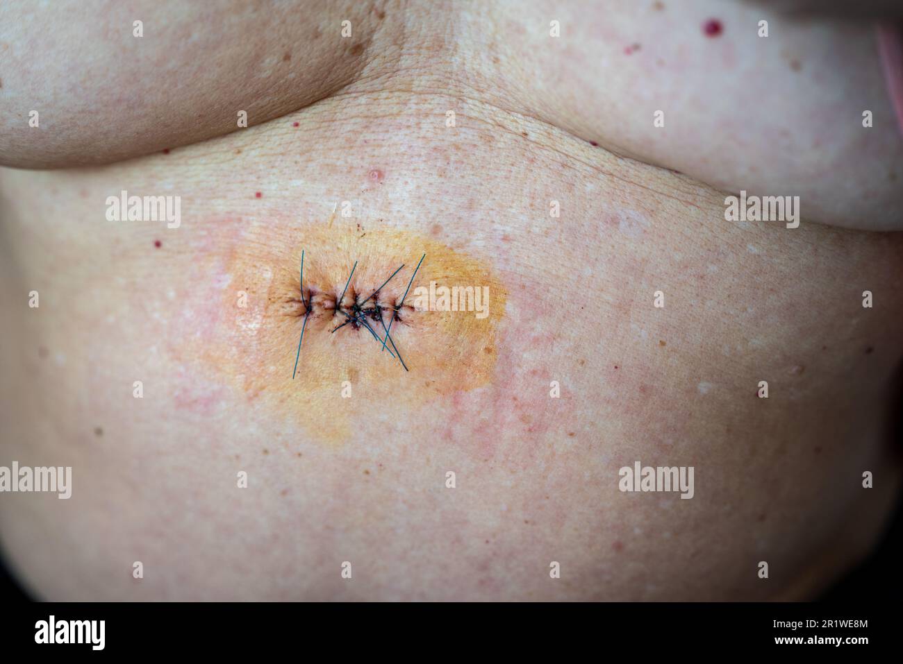 Frische Operationswunde mit Nähten nach Hautkrebsexzision unter postoperativer Versorgung mit antiseptischer Betadin-Desinfektion auf der Haut älterer Patienten Stockfoto
