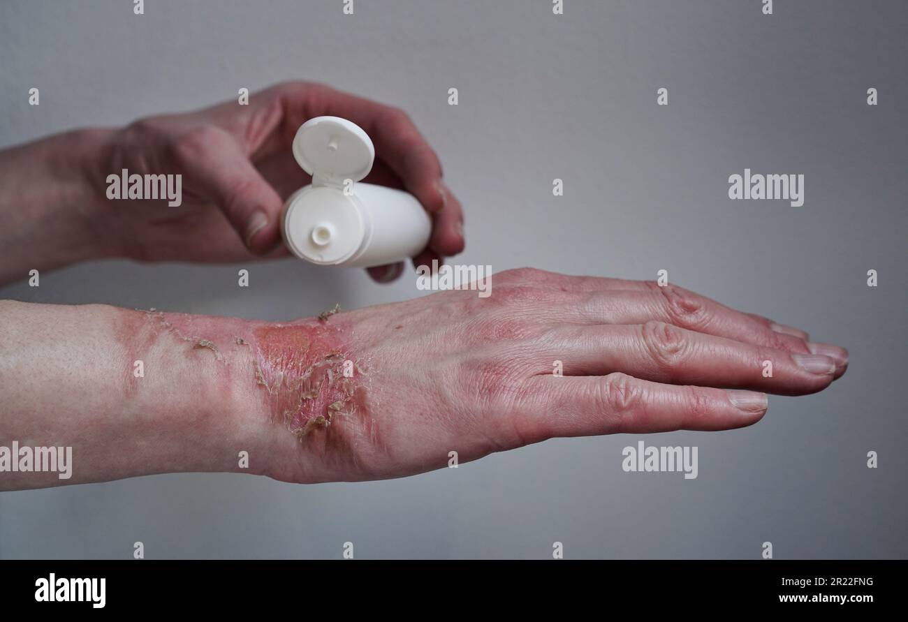 Modell-Flasche mit Creme heilender Salbe Frau Hand verbrannt mit kochendem Wasser mit geplatzten Blasen, beschädigte Haut, 1. oder 2. Grad Verbrennungen.schmerzhafte Wunde.T Stockfoto