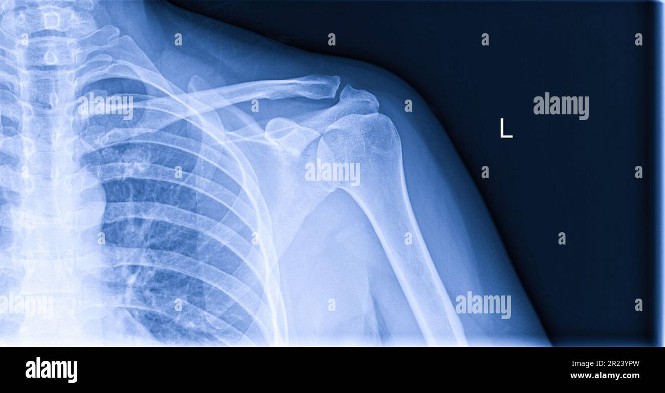 Röntgenbild von Schulterschmerzen, Schulterbandtendinitis, Schultermuskelbelastung Stockfoto