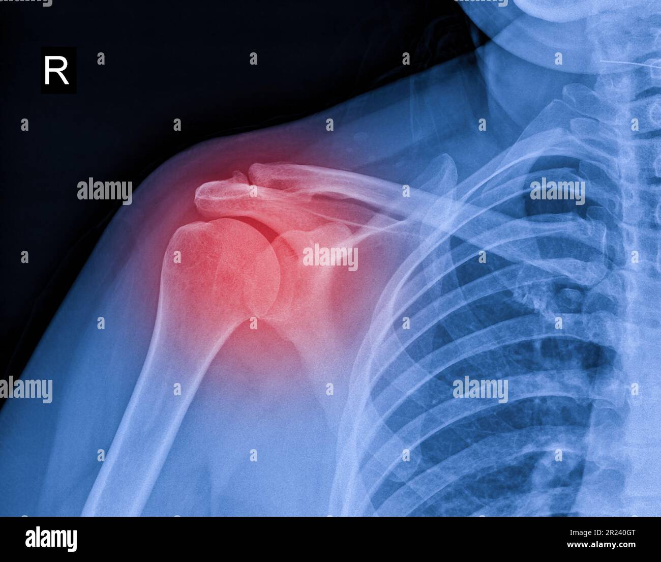 Röntgenbild von Schulterschmerzen, Schulterbandtendinitis, Schultermuskelbelastung Stockfoto