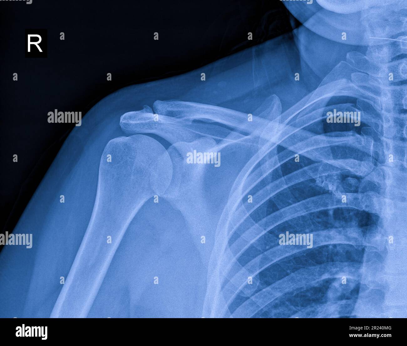 Röntgenbild von Schulterschmerzen, Schulterbandtendinitis, Schultermuskelbelastung Stockfoto