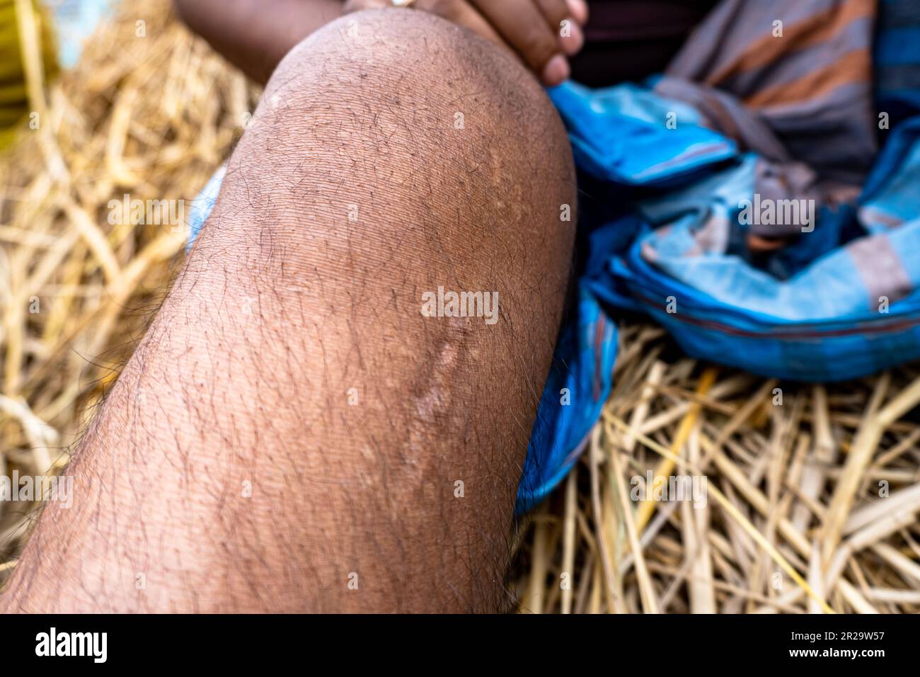 Vorderer Kreuzbanderriss Arthroskopie Knochenschmerzen geschwollener Bewegungsbereich Oberschenkelknochen Ruhe-Eis Behandlung erste-Hilfe-Heilung Stockfoto Vorderer Kreuzbanderriss Arthroskopie Knochenschmerzen geschwollener Bewegungsbereich Oberschenkelknochen Ruhe-Eis Behandlung erste-Hilfe-Heilung Stockfoto
