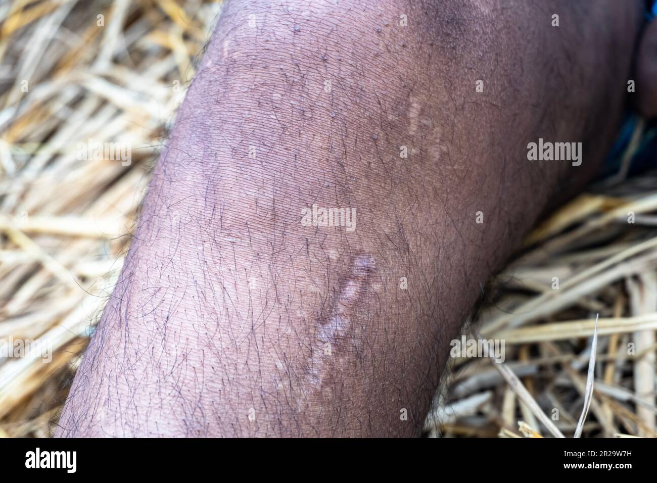 ACL-Verletzung, gerissenes vorderes Kreuzband. Stockfoto ACL-Verletzung, gerissenes vorderes Kreuzband. Stockfoto