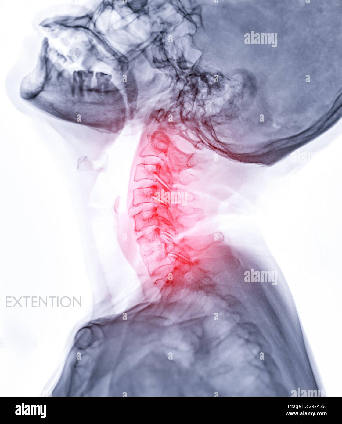 Röntgen-HWS- oder Röntgenbild der Halswirbelsäulenverlängerung zur diagnostischen Bandscheibenherniation, Spondylose und Fraktur. Stockfoto