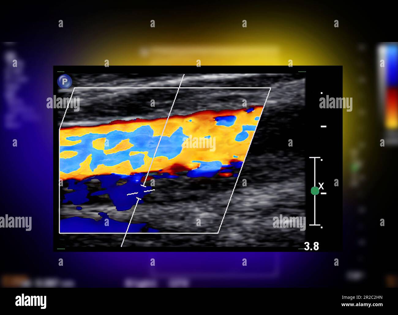 Ein DopplerUltraschall der A. carotis ist ein diagnostischer Test, der