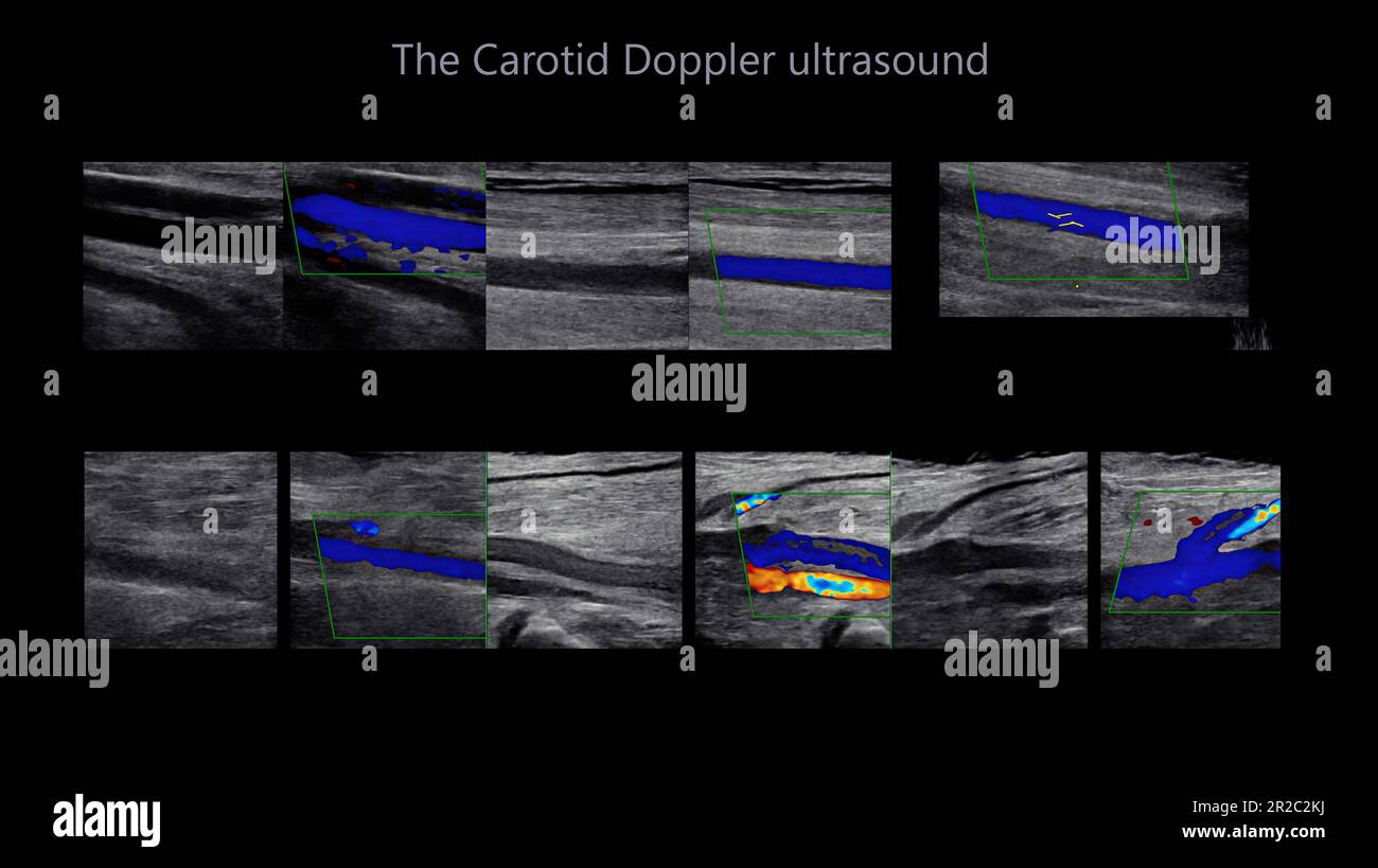 Ein DopplerUltraschall der A. carotis ist ein diagnostischer Test, der