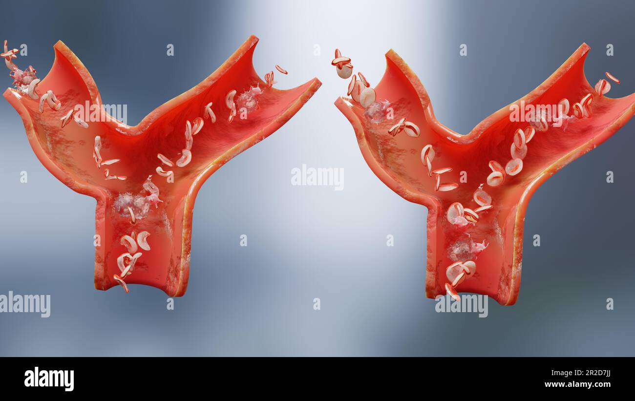 Sichelzellanämie Krankheit, medizinisch korrekt 3D Abbildung von Sicklekell, Blutgefäß mit normalen roten Blutkörperchen und erkrankten roten Blutkörperchen, Nein Stockfoto