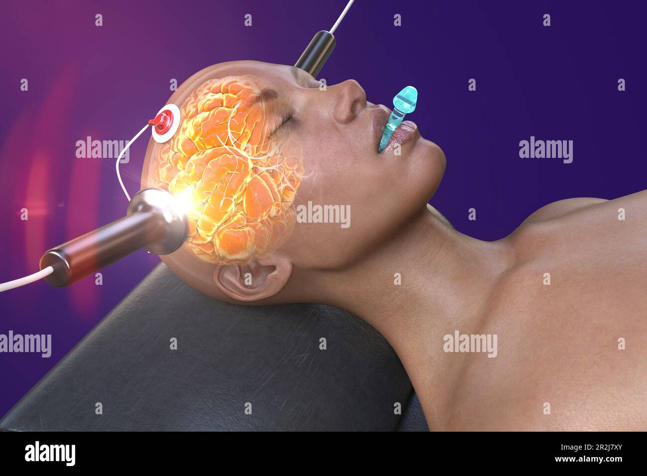 Elektrokrampftherapie, Illustration Stockfoto