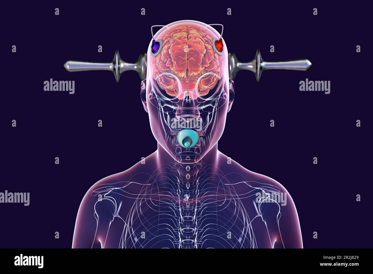 Elektrokrampftherapie, Illustration Stockfoto