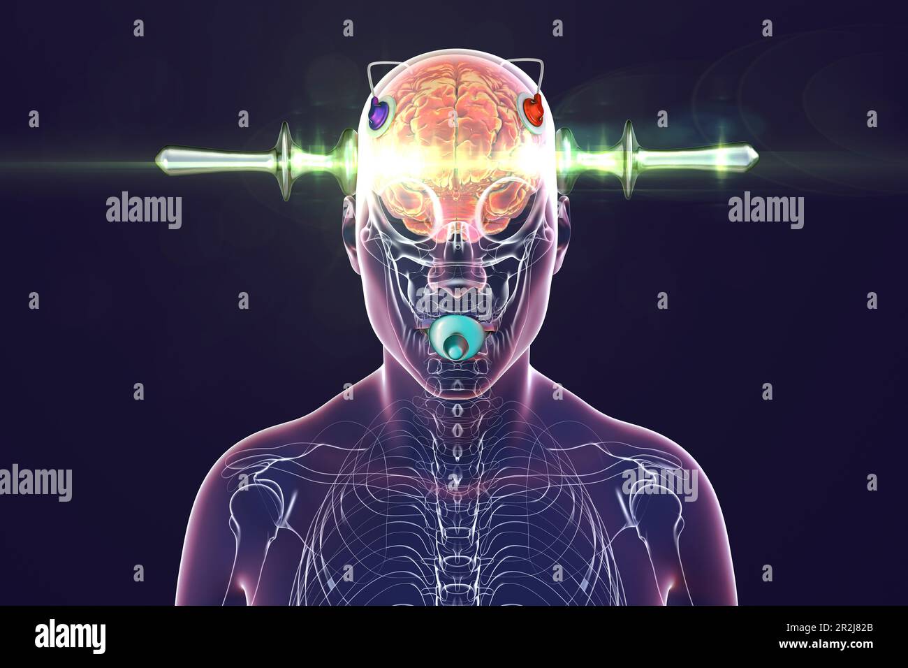 Elektrokrampftherapie, Illustration Stockfoto