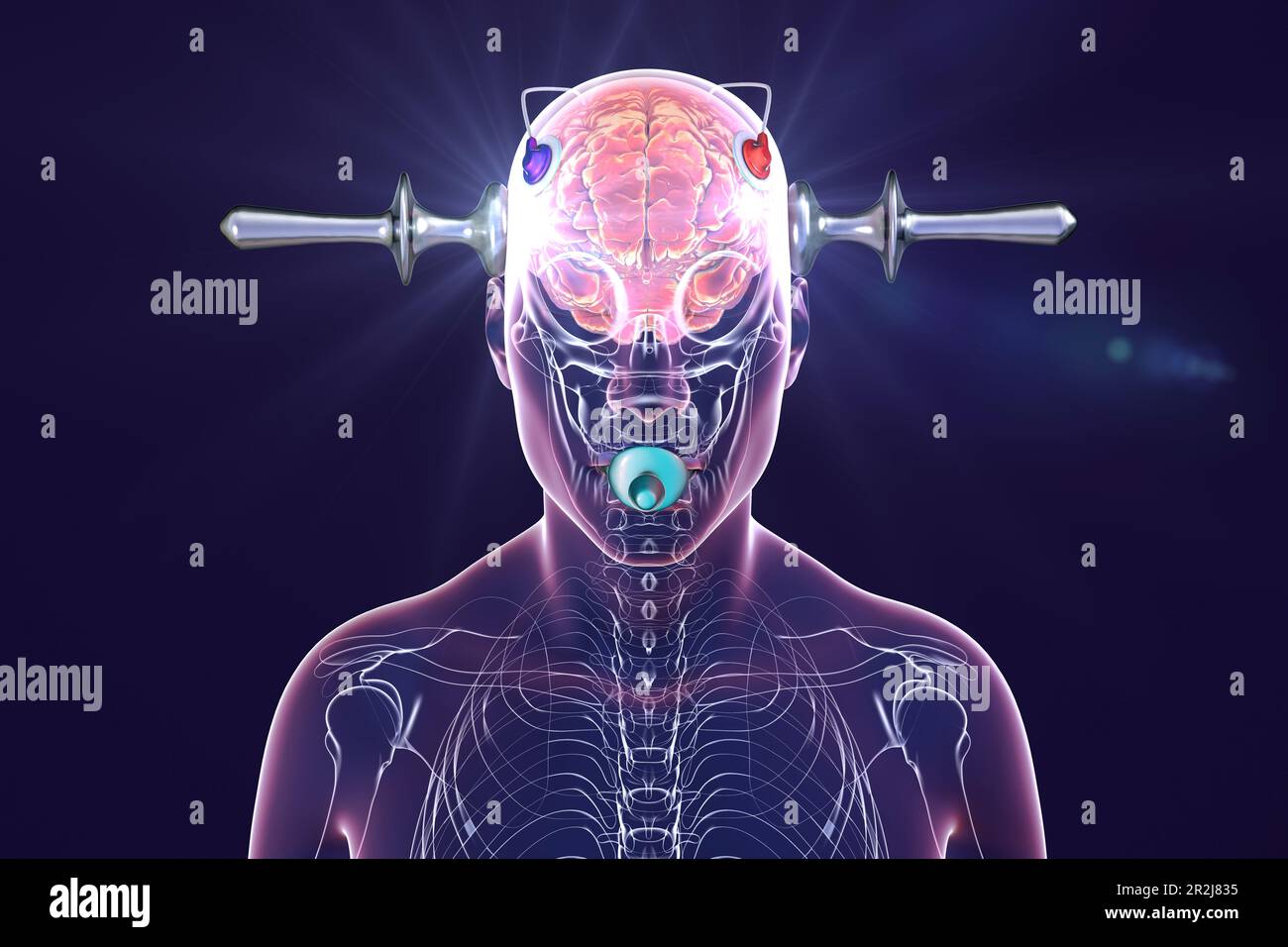 Elektrokrampftherapie, Illustration Stockfoto