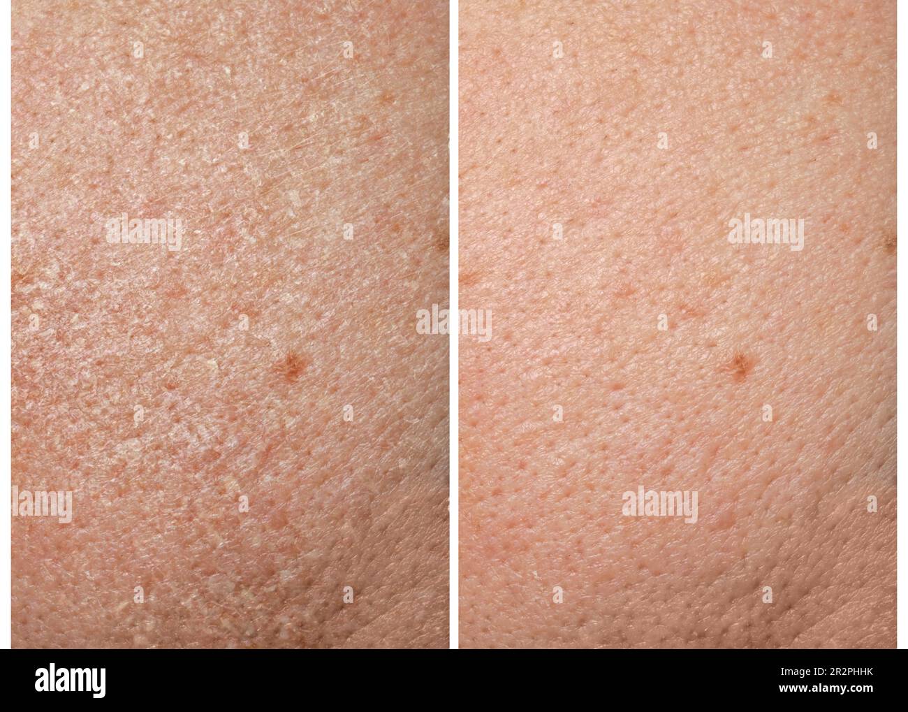 Collage zum Vergleich von trockener und feuchtigkeitsspendender menschlicher Haut, Nahaufnahme Stockfoto