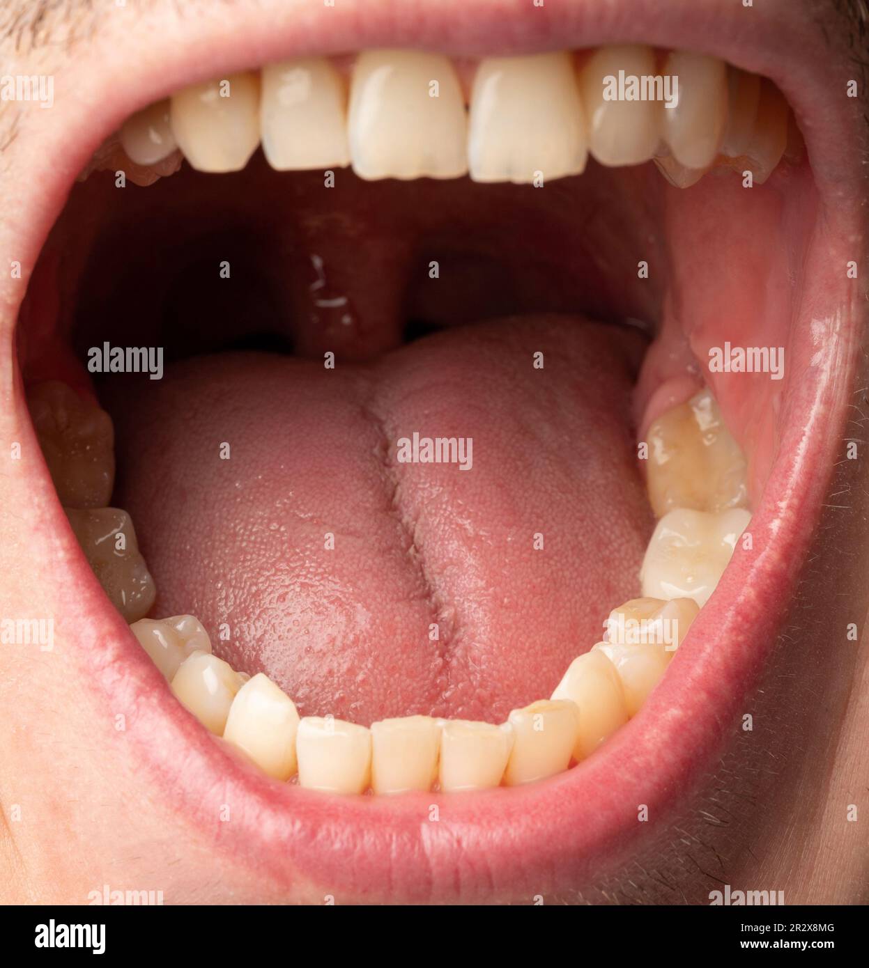 Halsschmerzen. Rosafarbene Zunge in Nahaufnahme mit offenem Mund Stockfoto