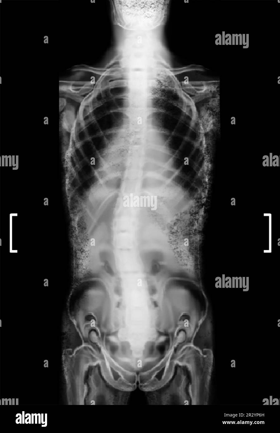 Röntgenbild der menschlichen Wirbelsäule mit Krümmung. Patient mit Skoliose Stockfoto