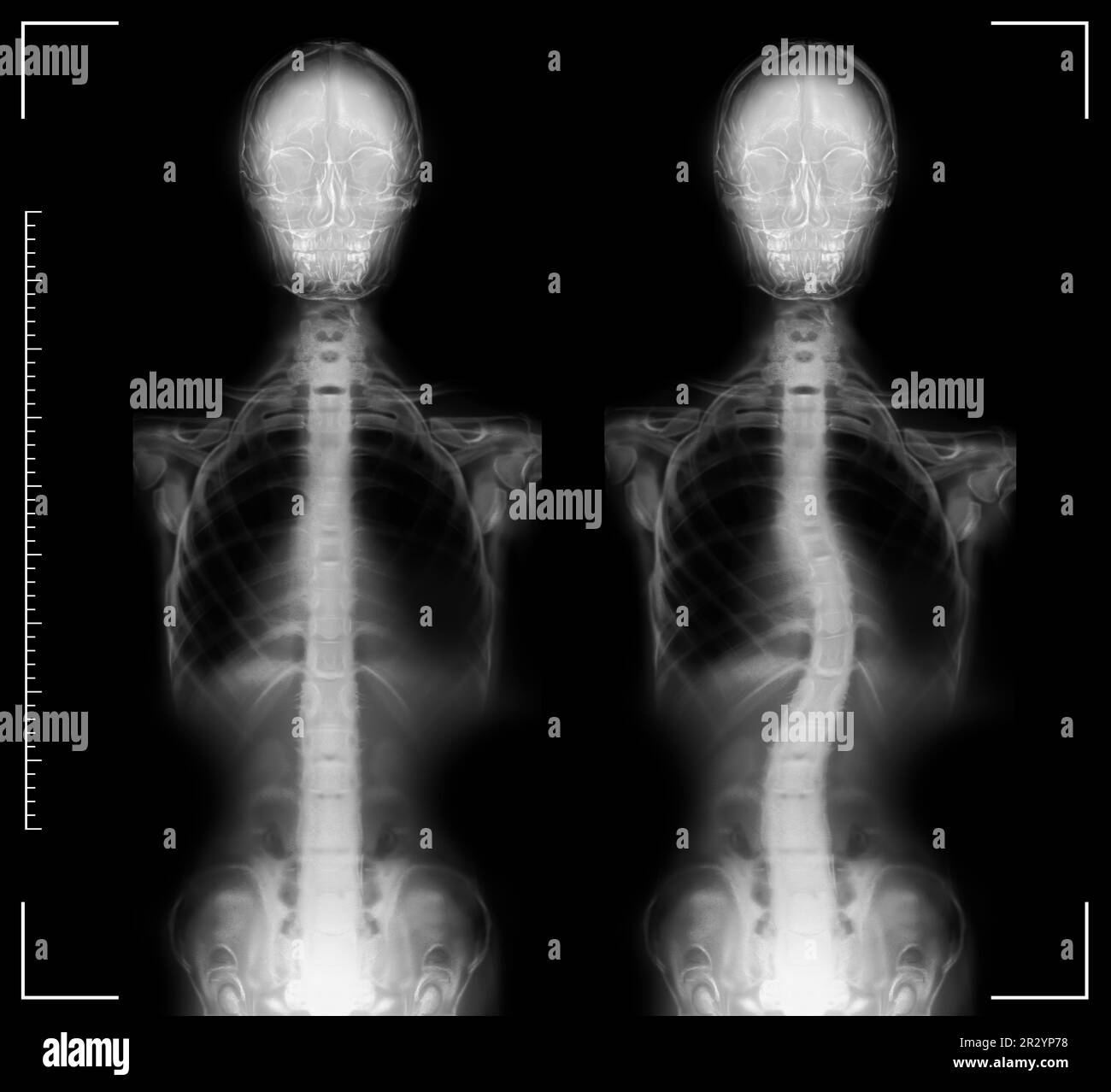 Röntgenaufnahmen der normalen und gekrümmten Wirbelsäule des Menschen. Patient mit Skoliose Stockfoto