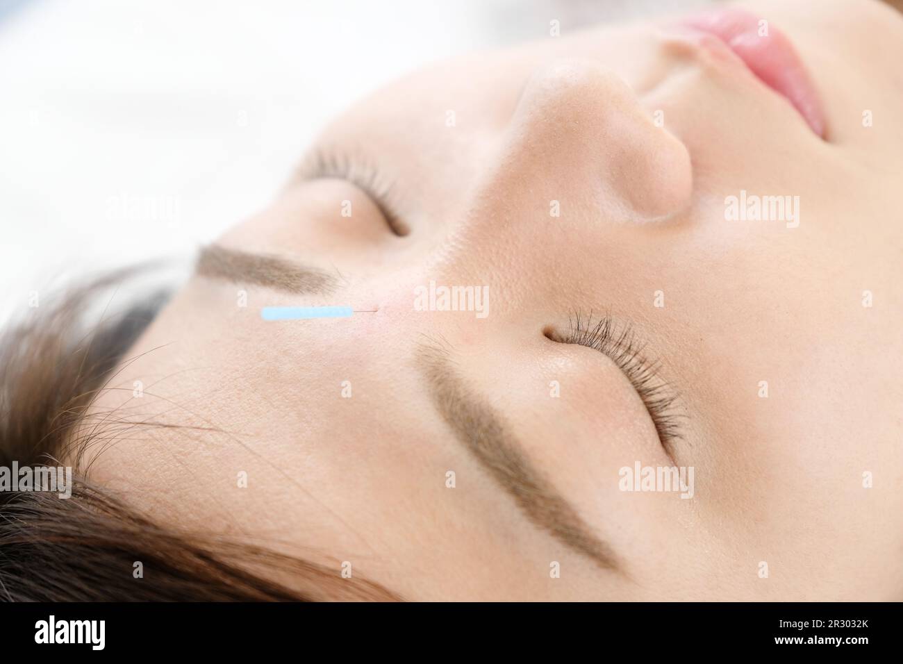 Eine Frau, die Akupunktur im Gesicht bekommt, in einer Akupunkturklinik Stockfoto