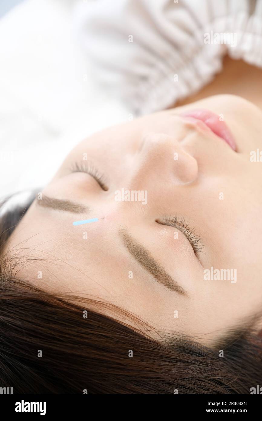 Eine Frau, die Akupunktur im Gesicht bekommt, in einer Akupunkturklinik Stockfoto