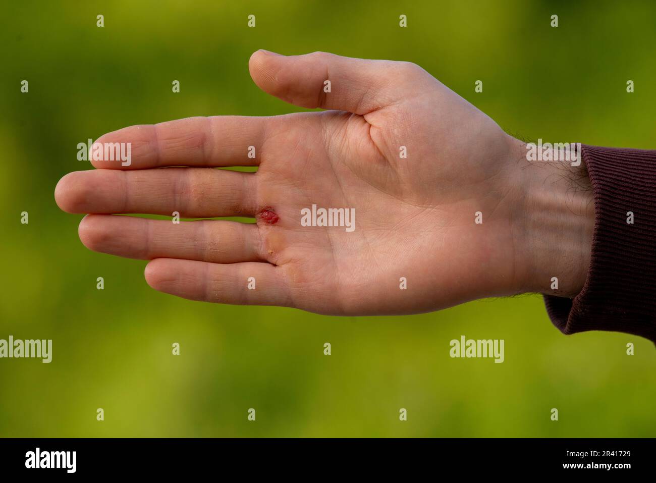 Menschlich verletzte Handflächen Hand litt Blasen und Kalluskerne Grüner natürlicher Hintergrund-Naht Stockfoto