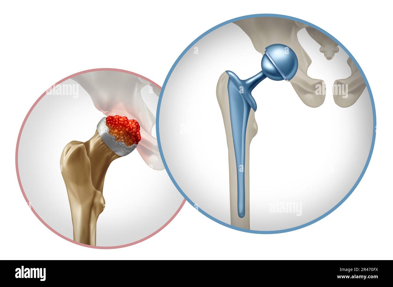 Hüftchirurgie und Beckengelenkersatz als künstliches Gelenk oder Prothese mit orthopädischer Chirurgie unter Einsatz einer Metallkugel Stockfoto