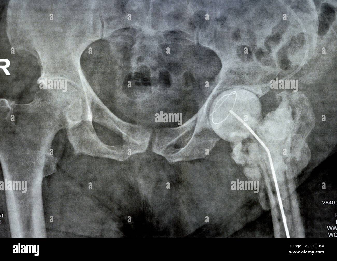 Das reine Röntgenstrahl des Hüftgelenks zeigt die linke transzervikale Femurkopffraktur mit temporärem antibiotikabelastetem Knochenzement hinten Stockfoto