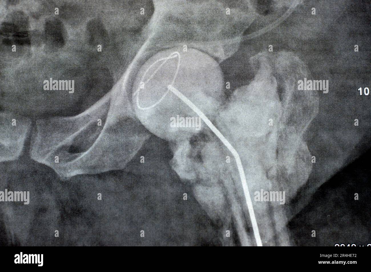 Das reine Röntgenstrahl des Hüftgelenks zeigt die linke transzervikale Femurkopffraktur mit temporärem antibiotikabelastetem Knochenzement hinten Stockfoto