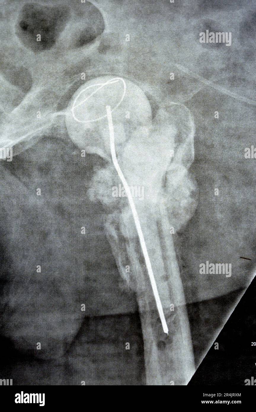 Das reine Röntgenstrahl des Hüftgelenks zeigt die linke transzervikale Femurkopffraktur mit temporärem antibiotikabelastetem Knochenzement hinten Stockfoto