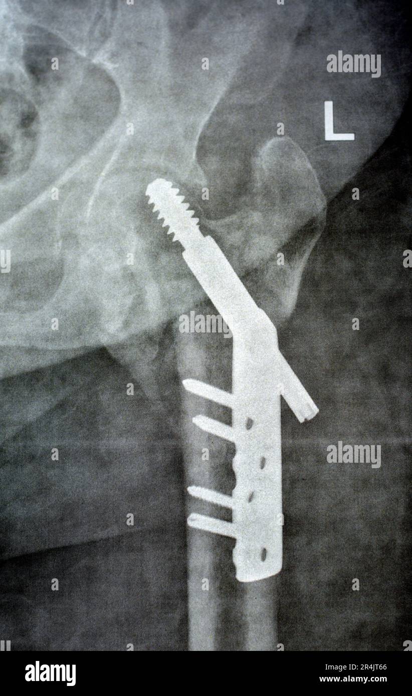 Linksseitige Hüfttranszervikalhalsfraktur nach DHS Dynamic Hüftschraube, Plain-Röntgen-PXR eines alten Patienten, einem schenkelkopferhaltenden Orthopäden Stockfoto
