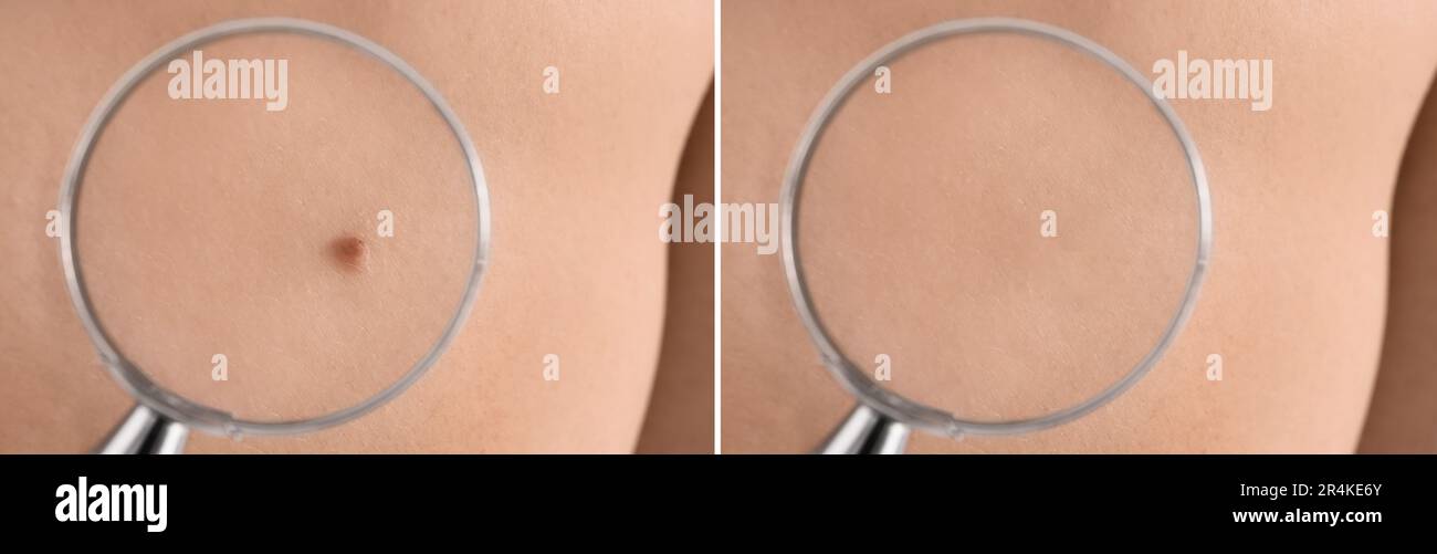 Collage mit Fotos des Rückens des Patienten vor und nach dem Entfernen des Leberfleckens, Nahaufnahme. Durch Lupe auf die Haut schauen Stockfoto