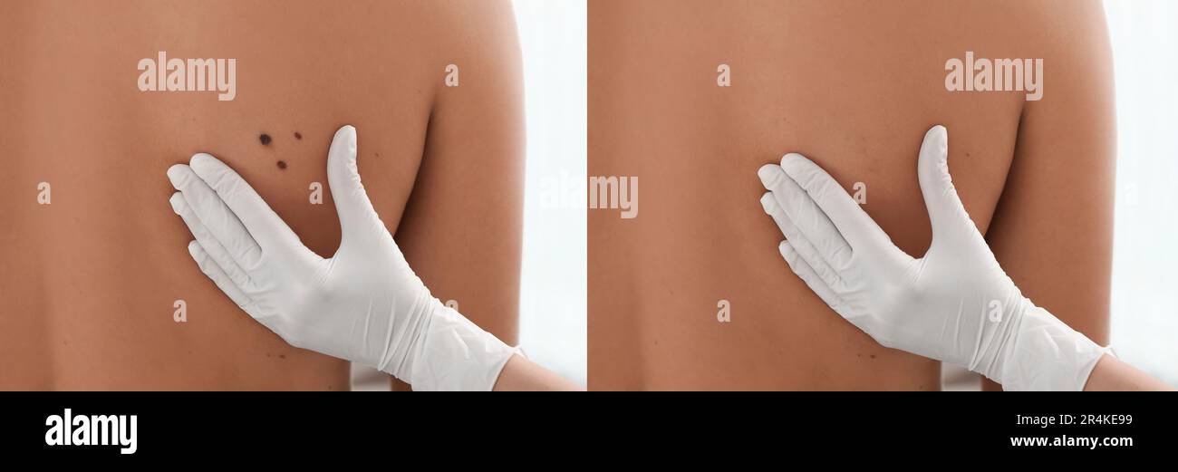 Collage mit Fotos des Rückens des Patienten vor und nach dem Entfernen des Leberfleckens, Nahaufnahme. Dermatologe, der die Haut des Menschen prüft Stockfoto