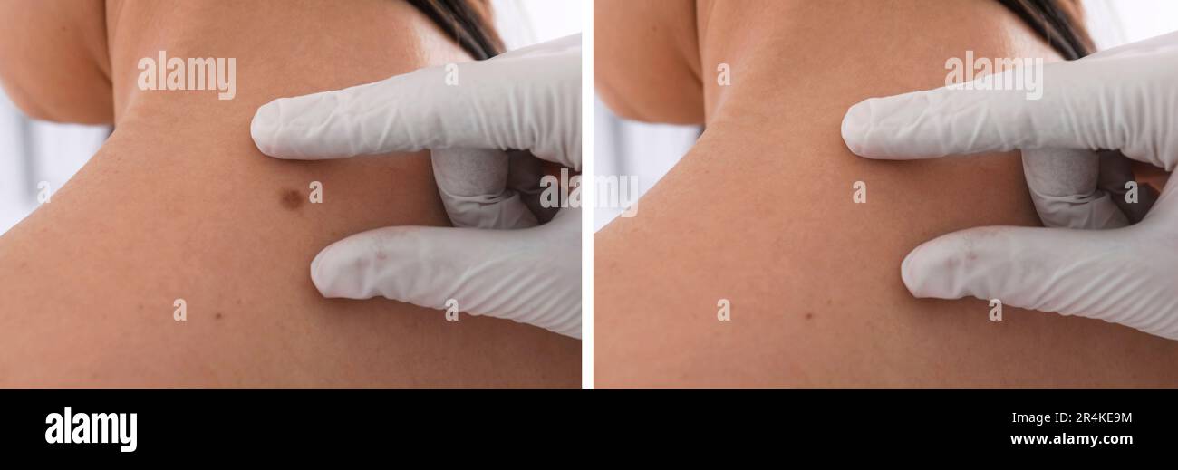 Collage mit Fotos des Rückens des Patienten vor und nach dem Entfernen des Leberfleckens, Nahaufnahme. Dermatologe, der die Haut einer Frau untersucht Stockfoto
