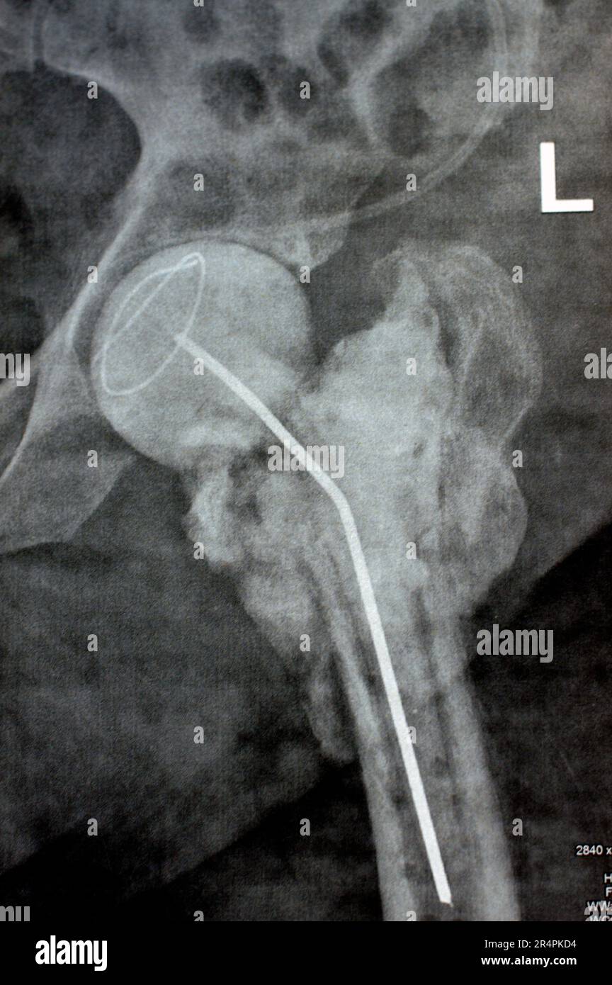 Das reine Röntgenstrahl des Hüftgelenks zeigt die linke transzervikale Femurkopffraktur mit temporärem antibiotikabelastetem Knochenzement hinten Stockfoto