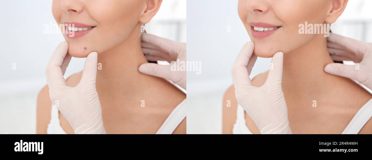 Collage mit Fotos des Gesichts des Patienten vor und nach dem Entfernen des Leberfleckens, Nahaufnahme. Dermatologe, der die Haut einer Frau untersucht Stockfoto