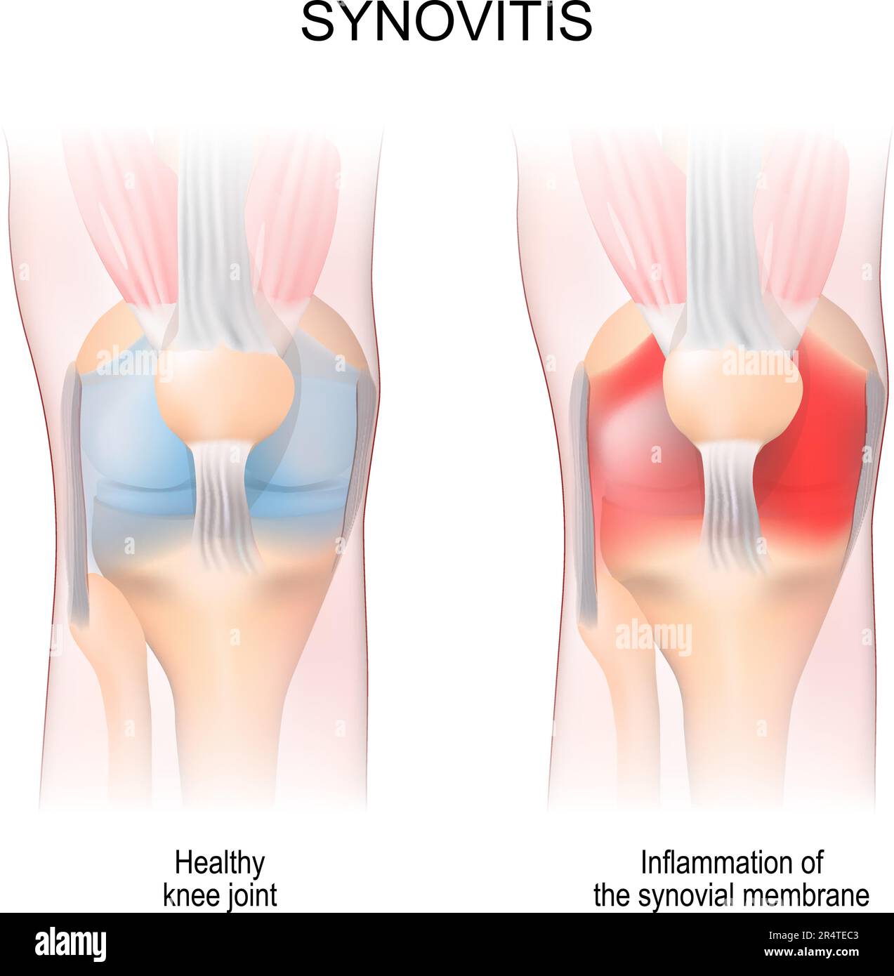 Synovitis. Die Anatomie des menschlichen Kniegelenks. Gesundes Gelenk und Entzündung der Synovialmembran. Vorderansicht. Anteriore Aspekte. Vektordarstellung Stock Vektor