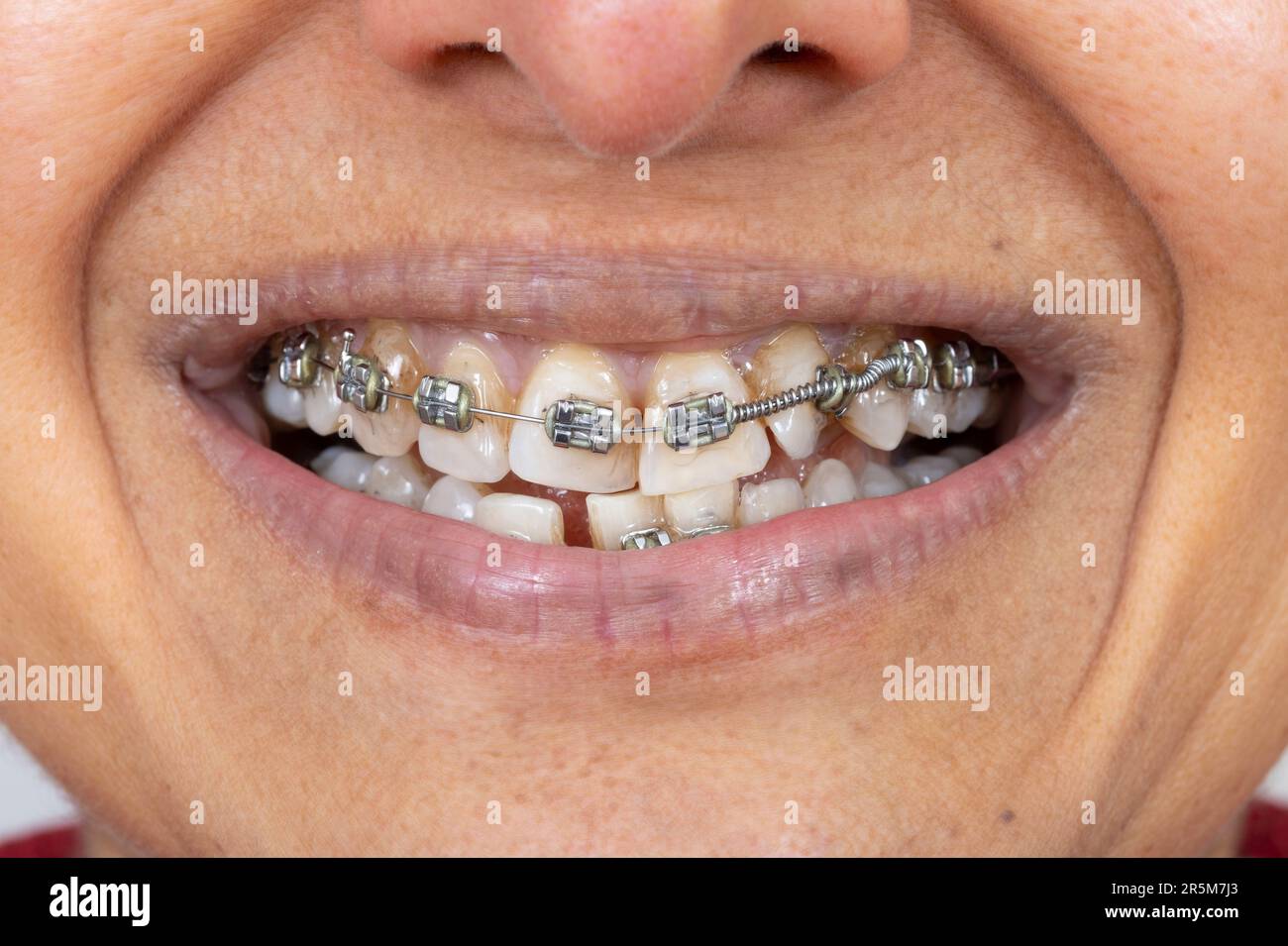 Metallspange an Zähnen einer mittelalterlichen indischen (britisch-asiatischen) Frau. Nur den Mund, lächeln. Stockfoto