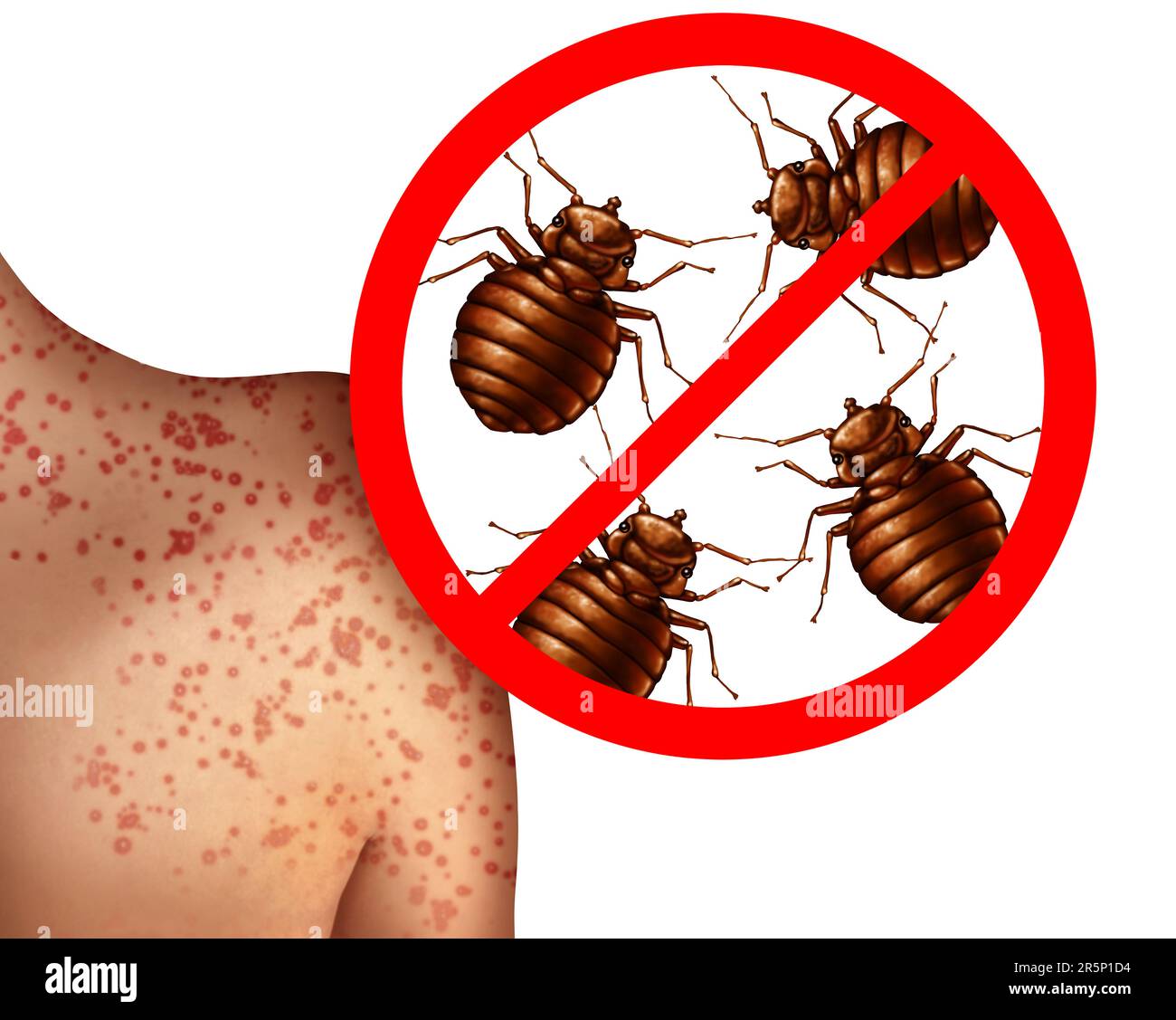 Bettwanzenstiche auf der menschlichen Haut oder Bettwanzenbefall Konzept als Vergrösserungsnaht parasitischer Insektenschädlinge als Hygienesymbol und Gesundheitsgefährdung Stockfoto