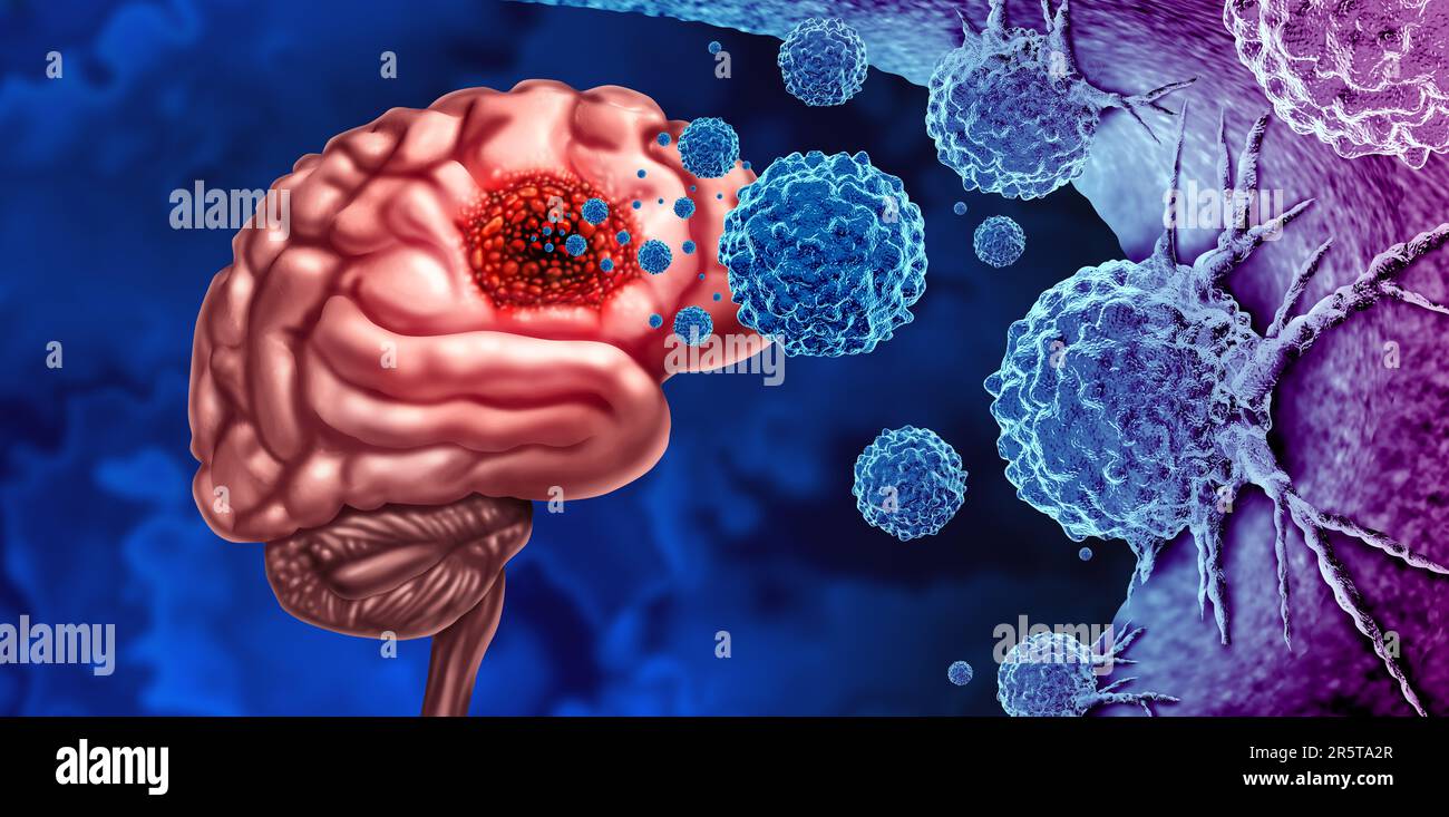 Gliom-Krebstumor als maligner Zellausbruch als neuronangreifende Hirnerkrankung als medizinisches Konzept neurologischer Erkrankungen mit 3D-Illustration Stockfoto