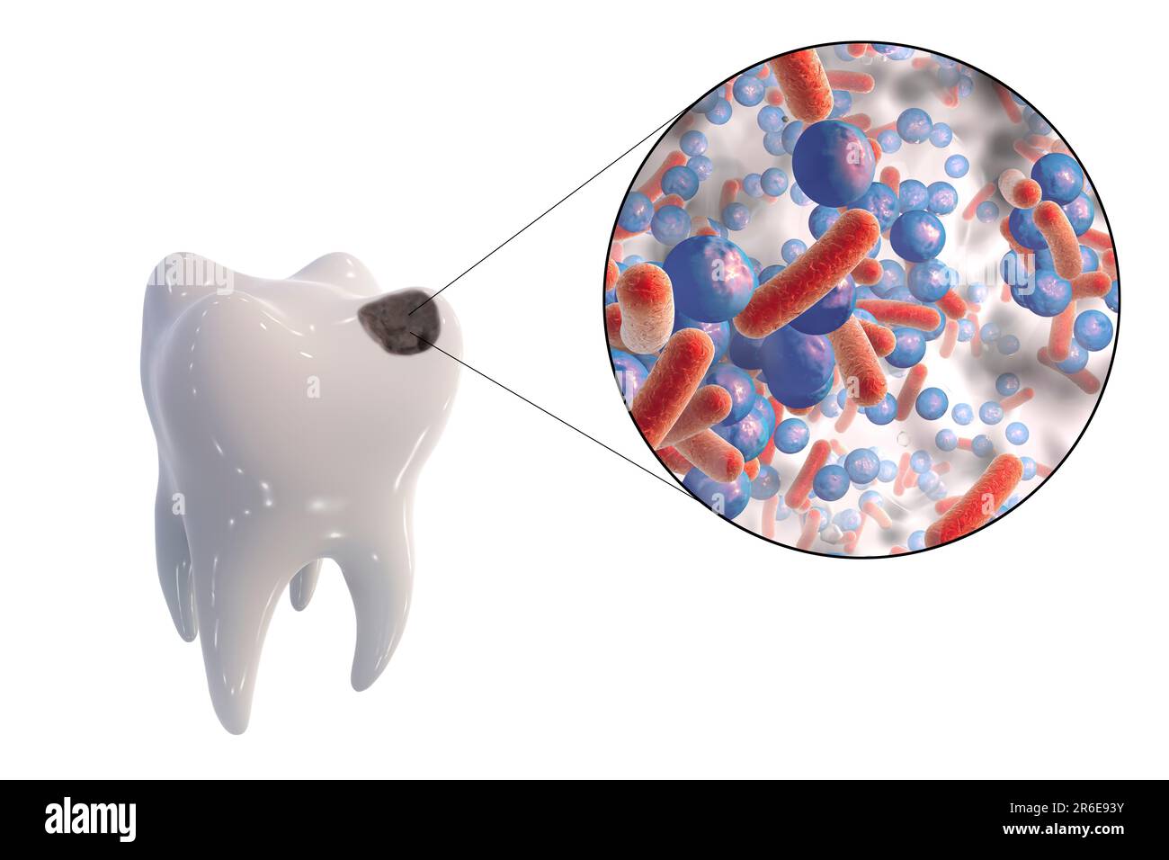 Zahnverfall. Computerdarstellung eines Zahnes mit Kavität und Nahaufnahme kariesbildender Bakterien. Stockfoto