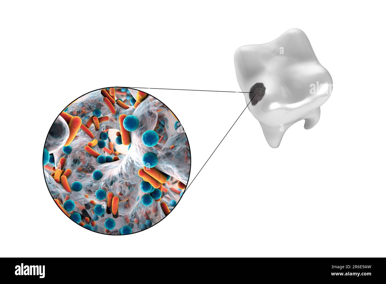 Zahnverfall. Computerdarstellung eines Zahnes mit Kavität und Nahaufnahme kariesbildender Bakterien. Stockfoto