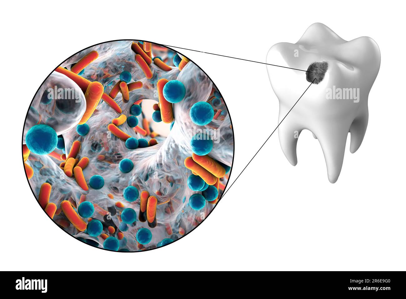 Zahnverfall. Computerdarstellung eines Zahnes mit Kavität und Nahaufnahme kariesbildender Bakterien. Stockfoto