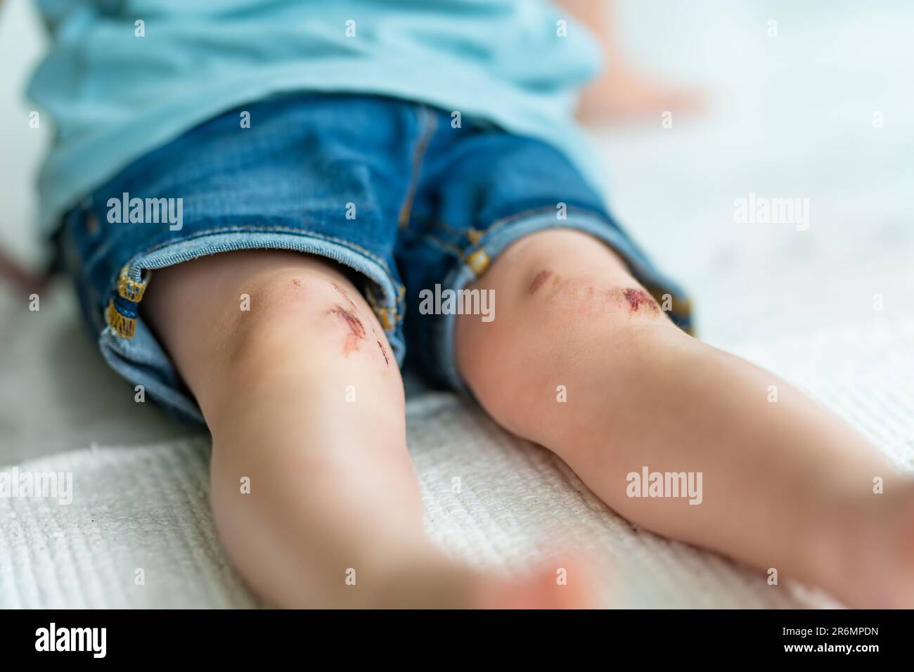 Ein kleiner Junge mit schmerzenden Kniescheiben. Eltern helfen ihrem Kind, eine erste-Hilfe-Knieverletzung durchzuführen, nachdem es einen Unfall hatte. Stockfoto