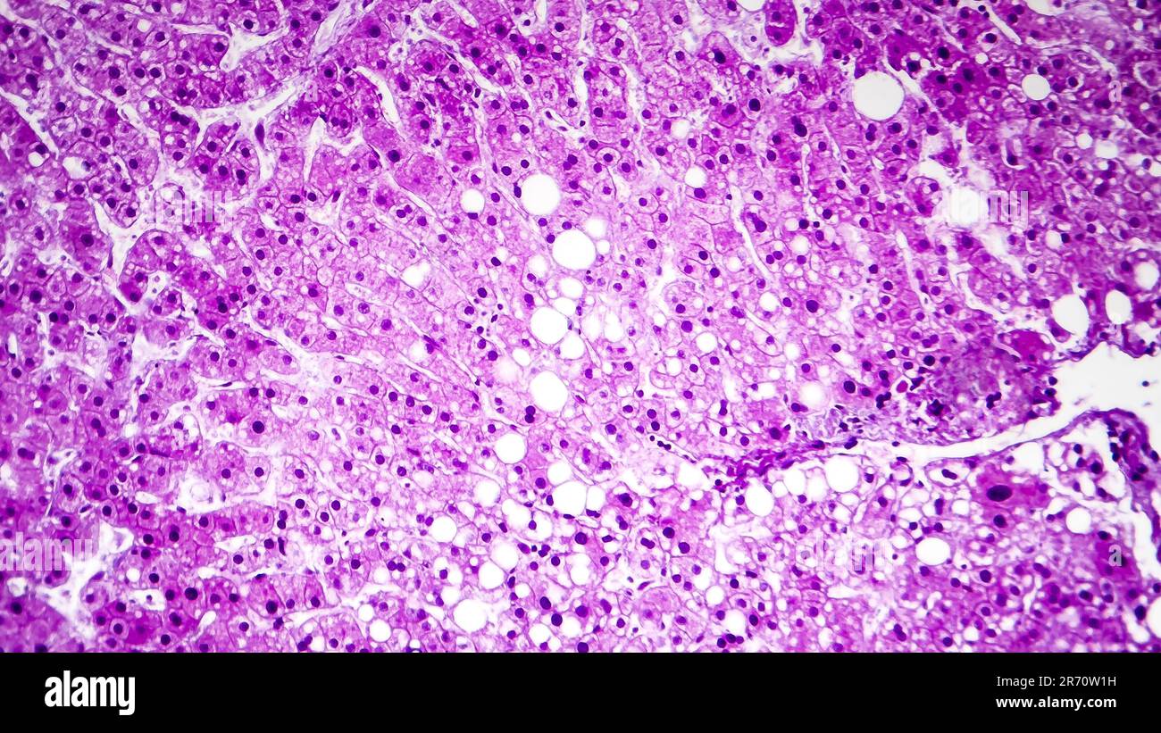 Histopathologie der Lebersteatose oder Fettleber. Lichtmikroskop, Foto unter dem Mikroskop Stockfoto