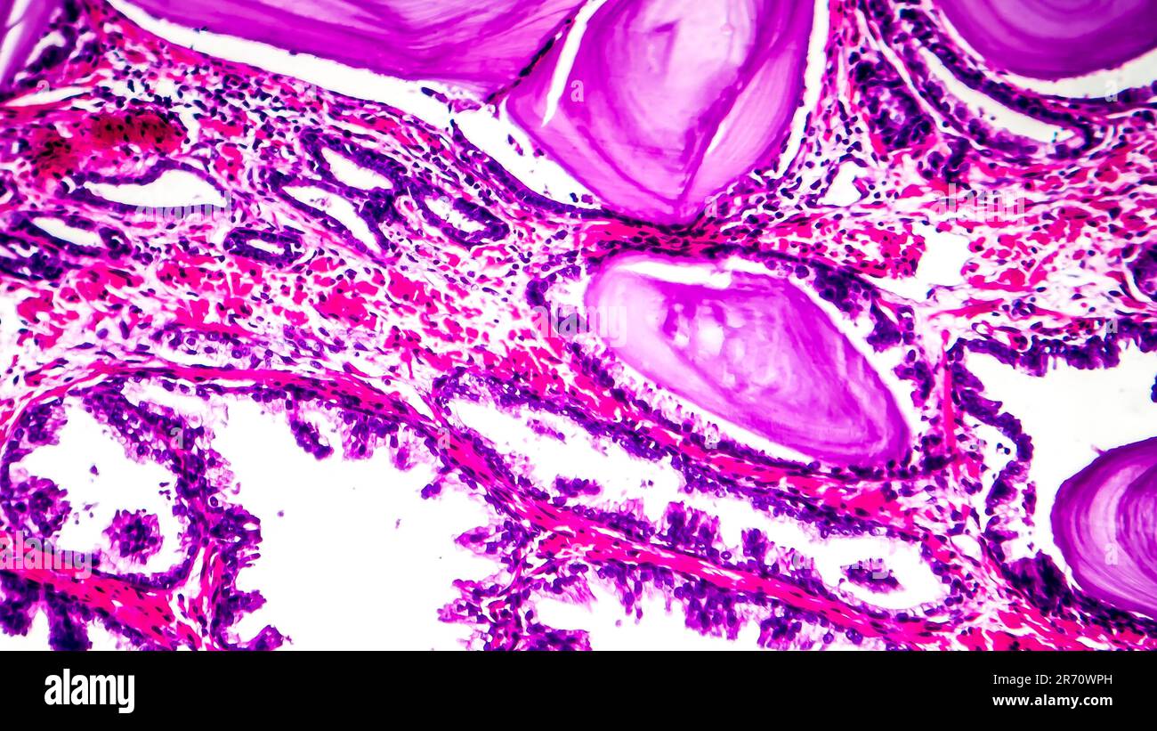 Histopathologie der Prostatahyperplasie, Lichtmikrographen, Foto unter dem Mikroskop Stockfoto