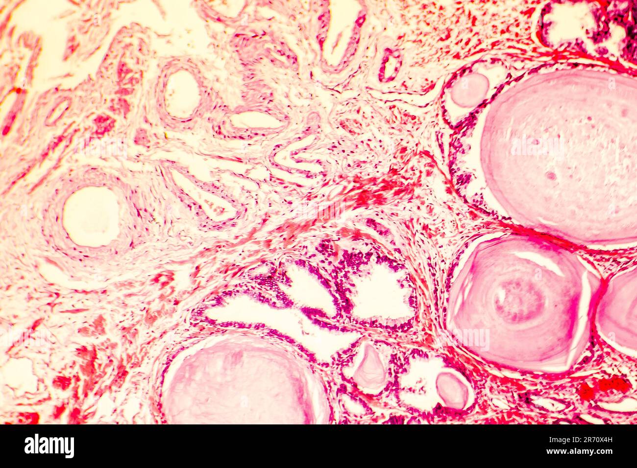 Prostatahyperplasie. Photomikrogramm mit Drüsenerweiterung, papilläre Vorsprünge im Lumen der Drüsen, zystische Dilatation mit Akkumulatio Stockfoto