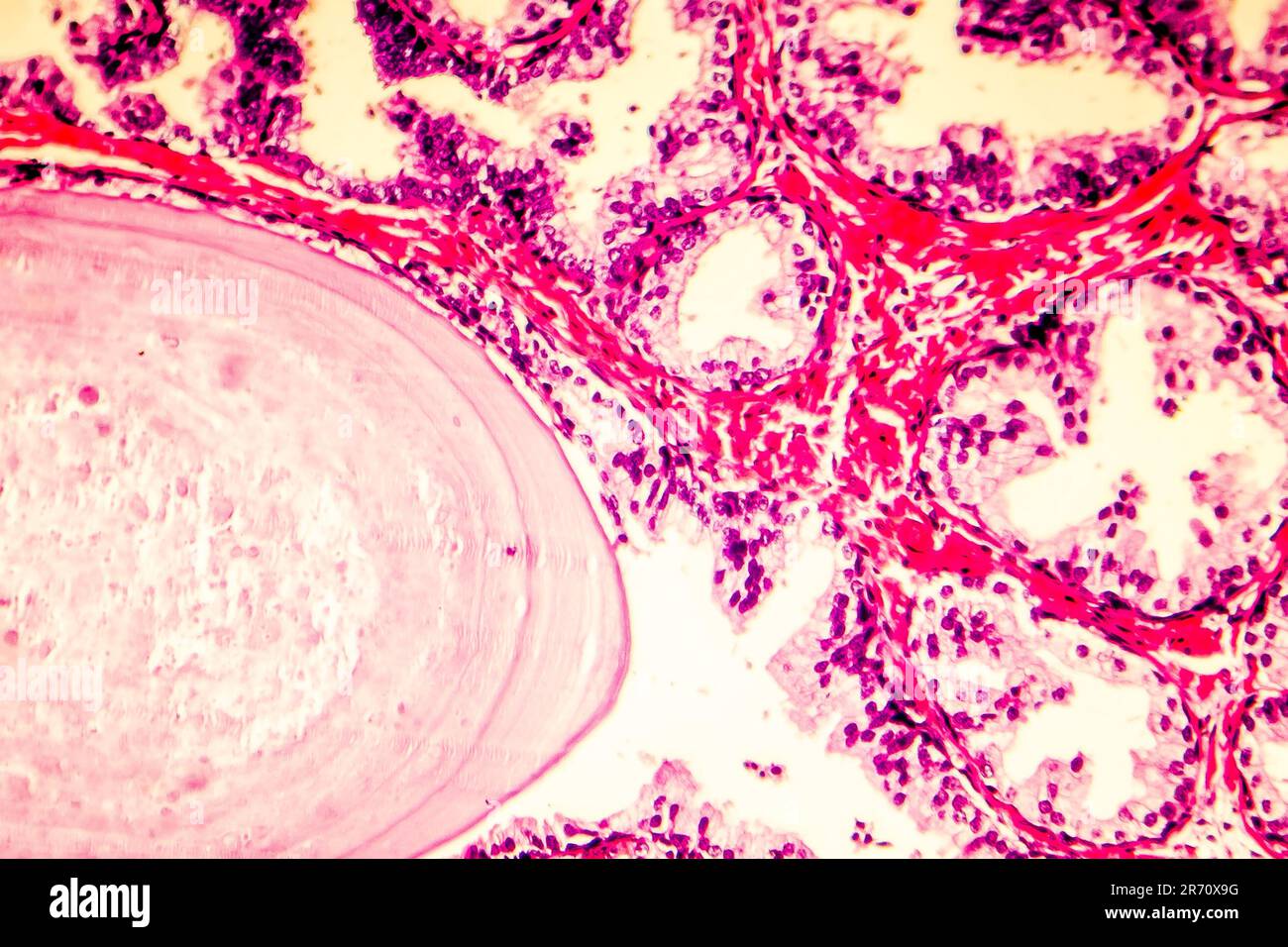 Prostatahyperplasie. Photomikrogramm mit Drüsenerweiterung, papilläre Vorsprünge im Lumen der Drüsen, zystische Dilatation mit Akkumulatio Stockfoto