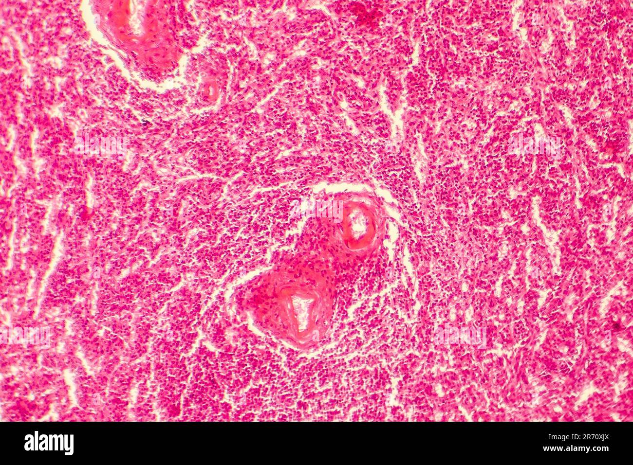 Hyaline Milzarteriendegeneration, Lichtphotomikrographisch Stockfoto