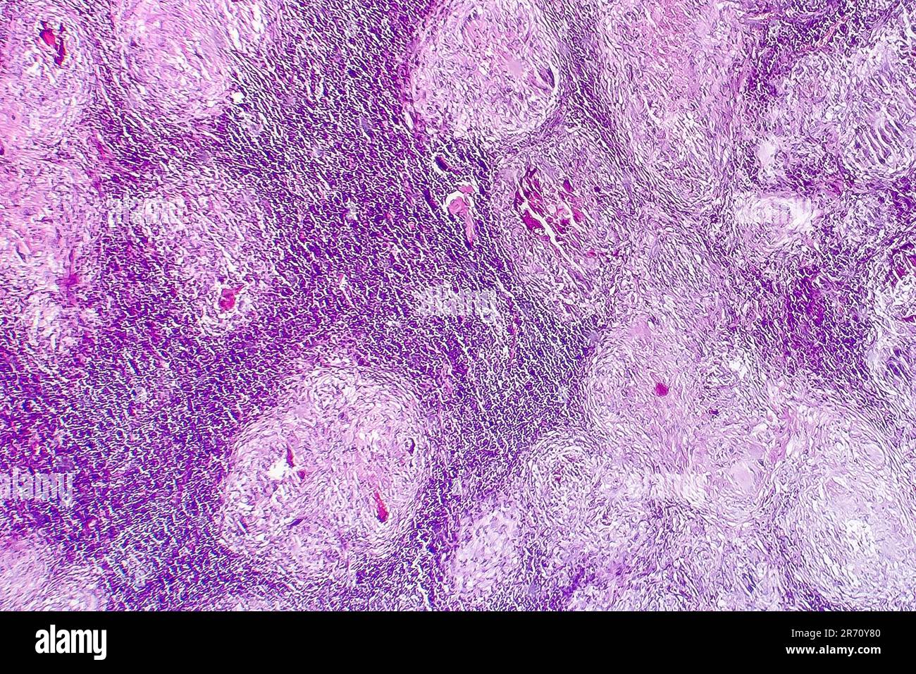 Kasuistischer Lymphknotennekrose, Lichtmikrogramm, Foto unter dem Mikroskop Stockfoto